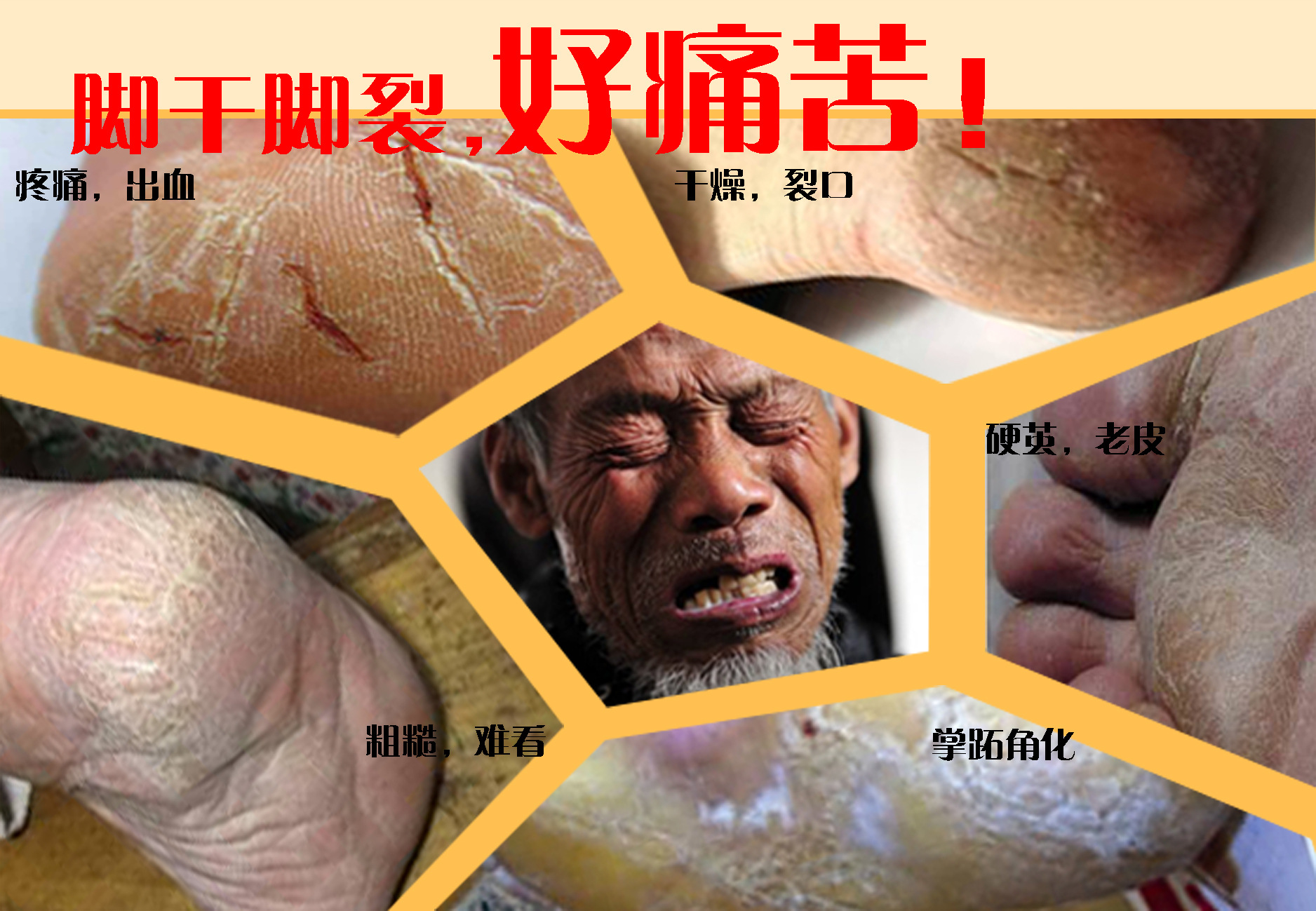 腳干裂，好痛苦